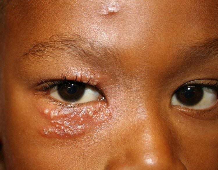 benh zona để lại nhiều biến chứng